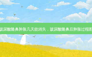 玻尿酸隆鼻肿胀几天能消失，玻尿酸隆鼻后肿胀过程图