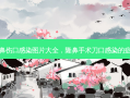隆鼻伤口感染图片大全，隆鼻手术刀口感染的症状