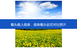 额头植入假体，假体额头前后对比照片