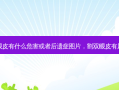 割双眼皮有什么危害或者后遗症图片，割双眼皮有风险吗