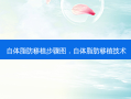 自体脂肪移植步骤图，自体脂肪移植技术