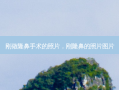 刚做隆鼻手术的照片，刚隆鼻的照片图片