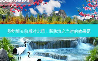 脂肪填充前后对比照，脂肪填充当时的效果是