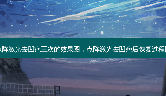 点阵激光去凹疤三次的效果图,点阵激光去凹疤后恢复过程图-第1张图片-美呗严选网 点阵激光去凹疤三次的效果图,点阵激光去凹疤后恢复过程图-第1张图片-美呗严选网