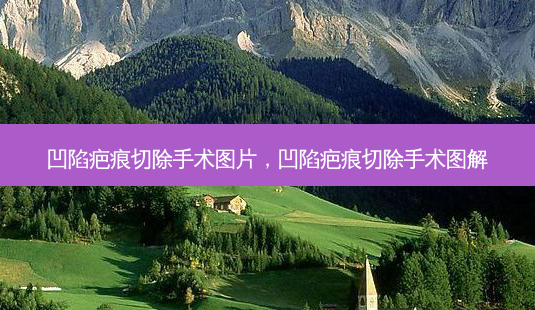 凹陷疤痕切除手术图片,凹陷疤痕切除手术图解-第1张图片-美呗严选网 凹陷疤痕切除手术图片,凹陷疤痕切除手术图解-第1张图片-美呗严选网
