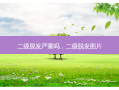 二级脱发严重吗，二级脱发图片
